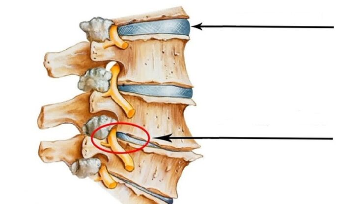 Spinal injury of cervical osteochondrosis