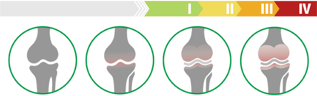 Clinical staging of knee arthropathy (degree of knee arthropathy)