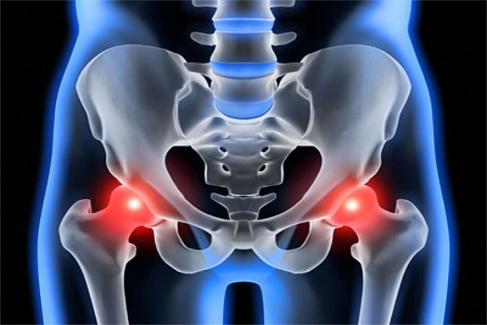 Hip deformity arthropathy (hip arthropathy)