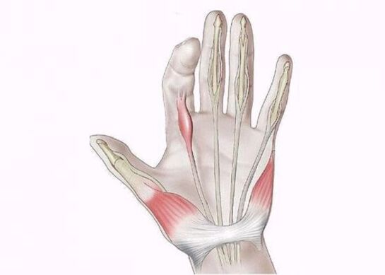 Tendon Inflammation Causes Finger Joint Pain