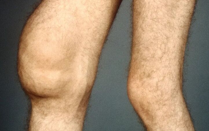 Traumatic arthritis of the knee joint
