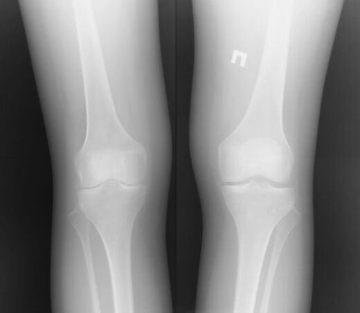 X-ray of knee joint