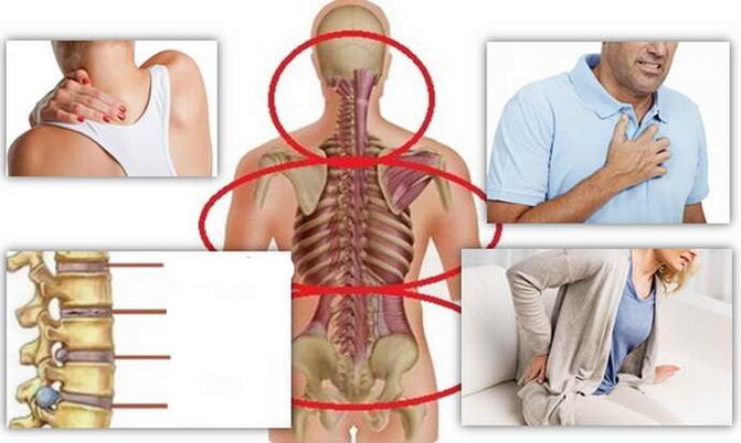 Diseases of osteochondrosis