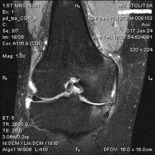 MRI shows knee osteoarthritis
