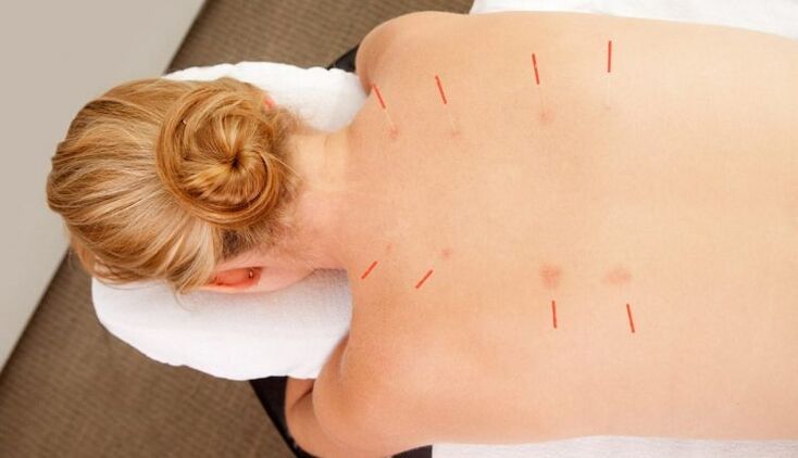 Acupuncture treats thoracic osteochondrosis with many advantages