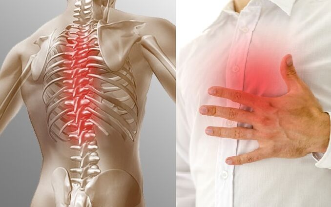 Chest osteochondrosis presents with pain and chest tightness